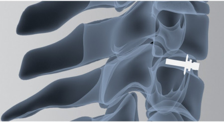 ARION – Cage Cervical Expandabil cu Lame de Fixare | Fuziune Anterioară Cervicală - Img 3