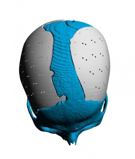 Cranioplasty patient-specific implants - Img 8