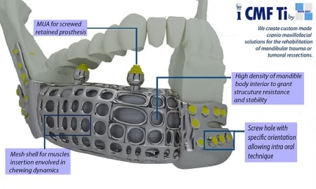 iCMF Ti – Implant Craniomaxilofacial Personalizat din Titan | BoneEasy® - Img 4