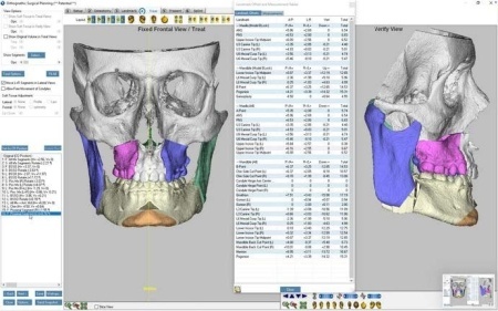 iMIOS – Sistem Personalizat pentru Chirurgie Ortognatică Minim Invazivă | BoneEasy® - Img 3