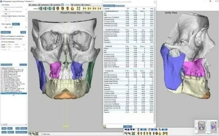 iMIOS – Sistem Personalizat pentru Chirurgie Ortognatică Minim Invazivă | BoneEasy® - Img 3
