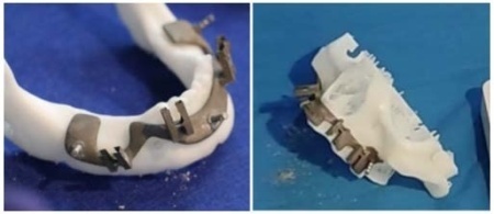 Implant personalizat pentru maxilar, subperiostal – Implantize Compact (Titanium / PEEK) (BoneEasy) - Img 2