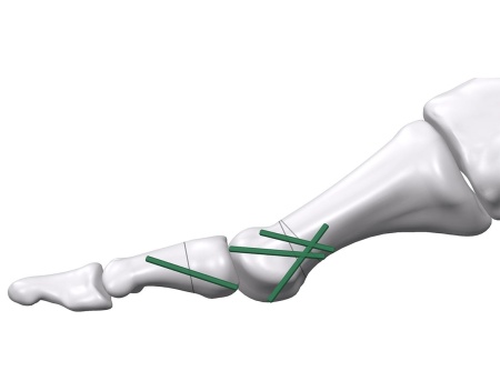 Inion FreedomPin™ – Pin ortopedic bioresorbabil pentru fracturi și osteotomii | Ø1.5–3.2 mm - Img 2