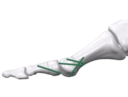 Inion FreedomPin™ – Pin ortopedic bioresorbabil pentru fracturi și osteotomii | Ø1.5–3.2 mm - Img 2
