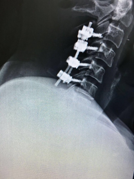 PORTHOS POSTERIOR CERVICAL SPINAL FIXATION SYSTEM - Img 5