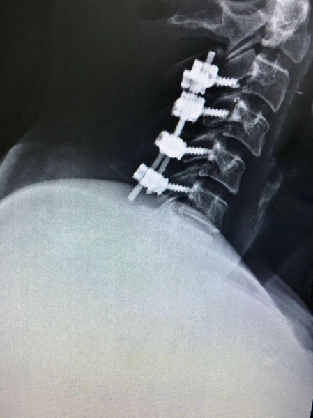 Sistem Șuruburi Poliaxiale PORTHOS | Fixare Coloană Cervicală - Img 5