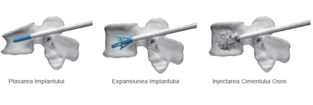 TRIPOD-FIX – Sistem Expandabil Vertebral pentru Fracturi de Compresie | Augmentare cu PMMA - Img 3