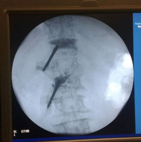 Vesta, Surub din Titan, fenestrat (Osteoporoza,  AP Trauma si Oncologie)