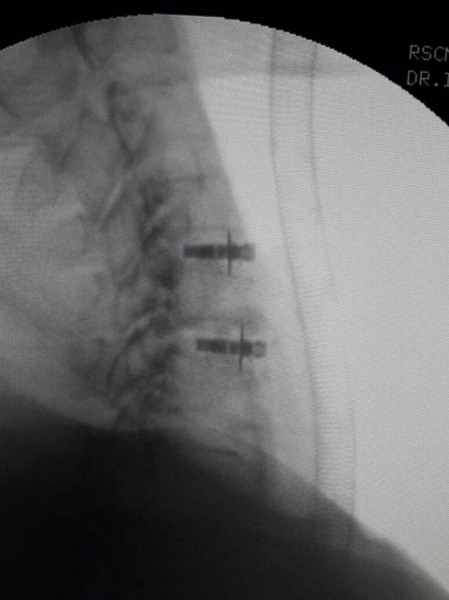 ARION EXPANDABLE BLADED CERVICAL PEEK CAGE - Img 4