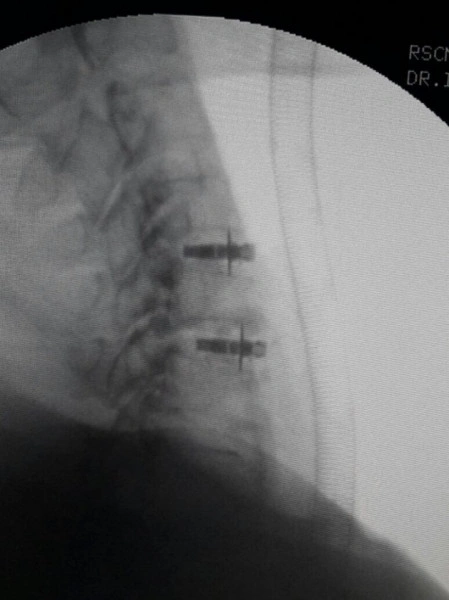 ARION EXPANDABLE BLADED CERVICAL PEEK CAGE - Img 4