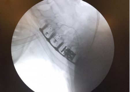 AURA, Suruburi fixare placa cervicala ( AP Trauma)