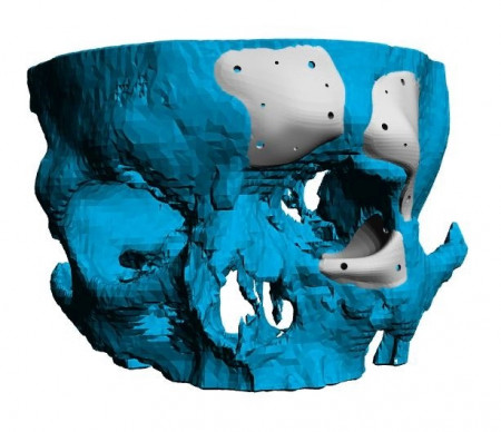 Cranioplasty plate for ENT defects - Img 2