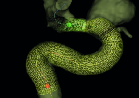 Dispozitiv de embolizare pentru tratamentul anevrismelor cerebrale - DERIVO® 2 - Img 2