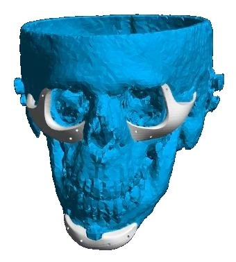 Implant personalizat pentru reconstructia fetei si craniului | 3di Germania - Img 3