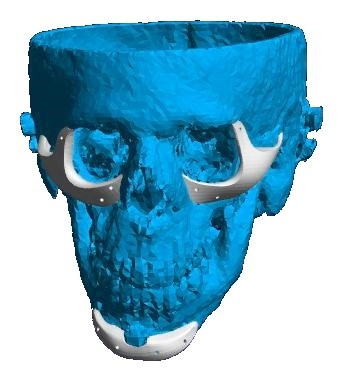 Placă Cranioplastie Personalizată 3D – Implant pentru Defecte BMF | 3di Germania - Img 3