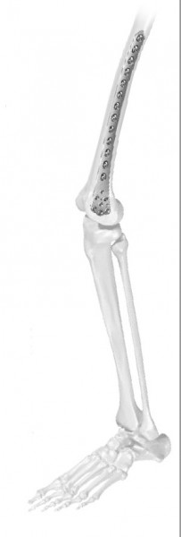 Placă de Femur Distal Vortex – Fixare Poliaxială