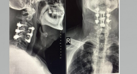 PORTHOS POSTERIOR CERVICAL SPINAL FIXATION SYSTEM - Img 6