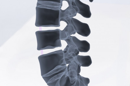 TALOS – Cage TLIF Lombar Posterior din PEEK | Fuziune Intervertebrală Osimplant - Img 2