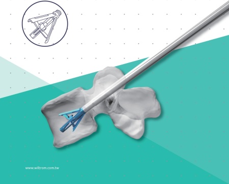 TRIPOD-FIX – Sistem Expansibil Vertebral pentru Fracturi de Compresie | Augmentare cu PMMA