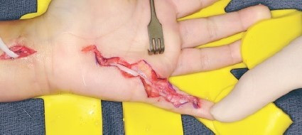 Universal Tendon Spacer U.T.S. – Distanțier Tendinos din Silicon pentru Reconstrucția Tendoanelor Flexorilor și Extensorilor - Img 5
