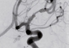 Cateter cu balon PTA pentru tratamentul stenozei intracraniene - NeuroSpeed® - Img 4