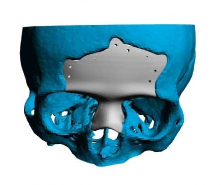 Cranioplasty plate for ENT defects - Img 3