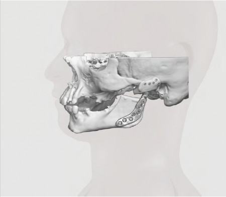 Endoproteză TMJ Specifică Pacientului – Soluție 3D Personalizată Ortho Baltic