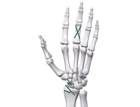 Inion FreedomPin™ – Pin ortopedic bioresorbabil pentru fracturi și osteotomii | Ø1.5–3.2 mm