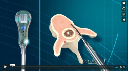 PediGuard® Curbat – Dispozitiv de Monitorizare Neuronală în Timp Real cu Vârf Direcționat - Img 2