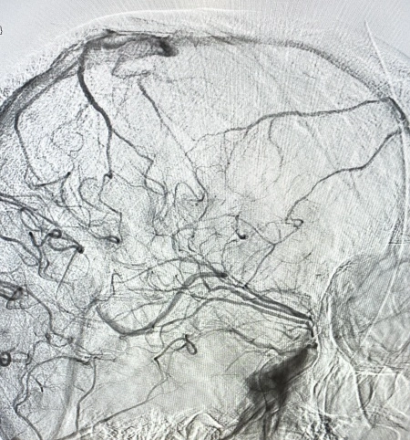 Pictura abstracta: The STROKE ( Accidentul Vascular Cerebral) sau Omul din Copacul Creierului - Img 6
