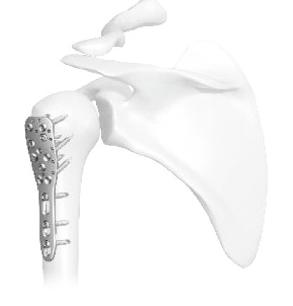 Placă Humerus Proximal– Tratament Fracturi de Cap Humeral | Sistem Vortex Sanatmetal