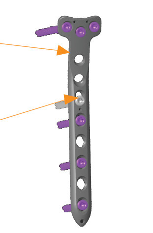 Placa de tibie proximala in T poliaxiala pentru osteosinteza fracturii de tibie Enlife