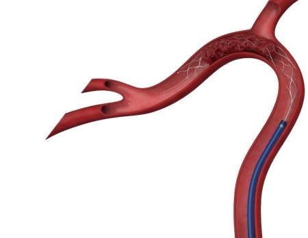 THROMBITE™ – Stent Retriever pentru Trombectomie | Zylox-Tonbridge Medical - Img 2