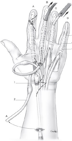 Universal Tendon Spacer U.T.S. – Distanțier Tendinos din Silicon pentru Reconstrucția Tendoanelor Flexorilor și Extensorilor