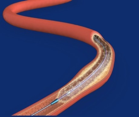 ZENFluxion™ – Balon PTA cu Paclitaxel | Zylox-Tonbridge - Img 2