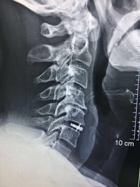 ARION EXPANDABLE BLADED CERVICAL PEEK CAGE - Img 5