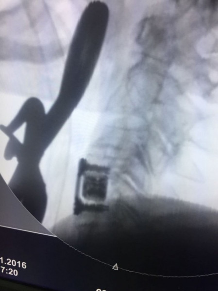 AURA, Suruburi fixare placa cervicala ( AP Trauma)
