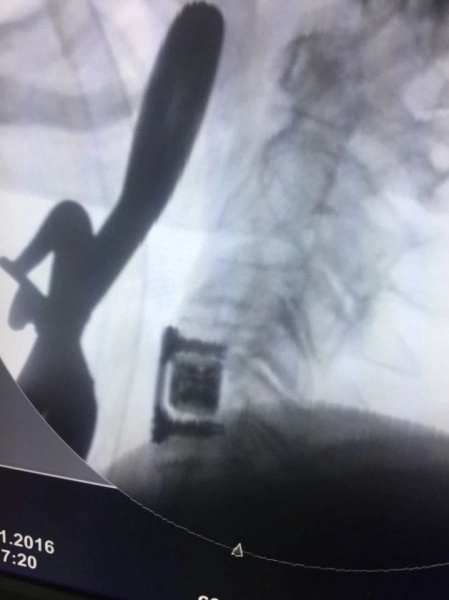 AURA, Suruburi fixare placa cervicala ( AP Trauma)