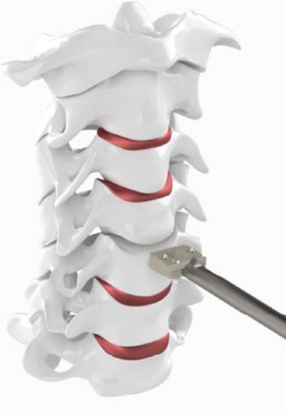 Hernie de Disc Cervicala, Cage Cervical din PEEK Bia