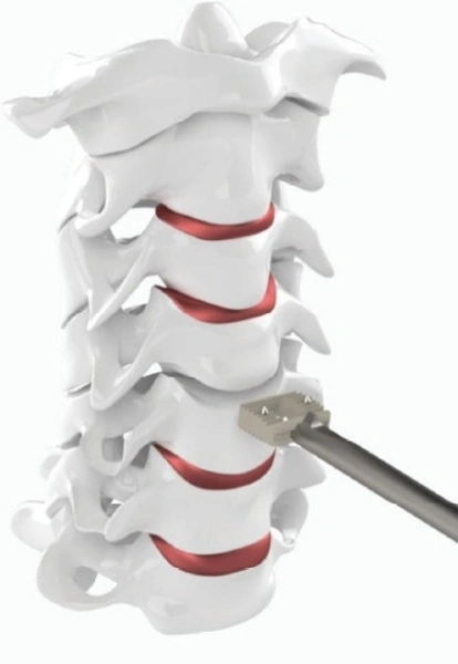 Hernie de Disc Cervicala, Cage Cervical din PEEK Bia