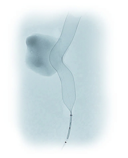 Dispozitiv de embolizare pentru tratamentul anevrismelor cerebrale - DERIVO® 2 - Img 3