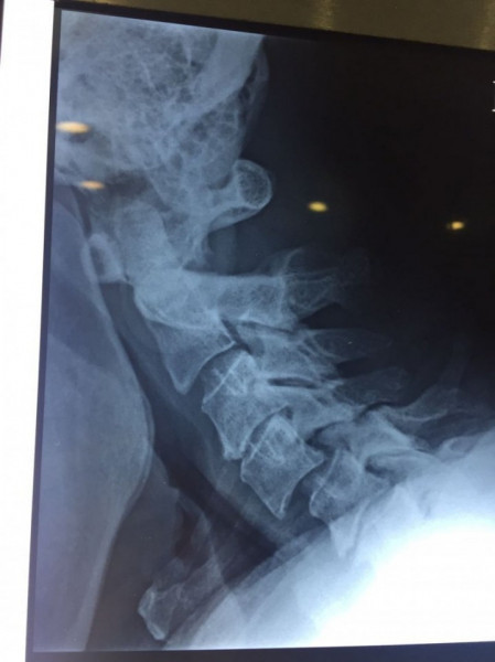 EOS Hybrid – Cage Cervical din PEEK cu Lamă de Fixare | Fuziune ACDF Stabilă - Img 3