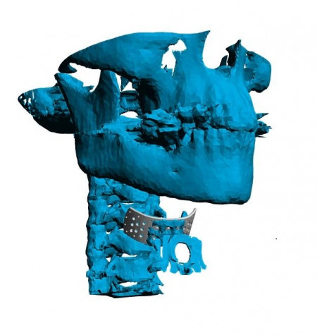 Implant Personalizat pentru Cranioplastie ORL – Soluție 3D Precise de la 3di Germania