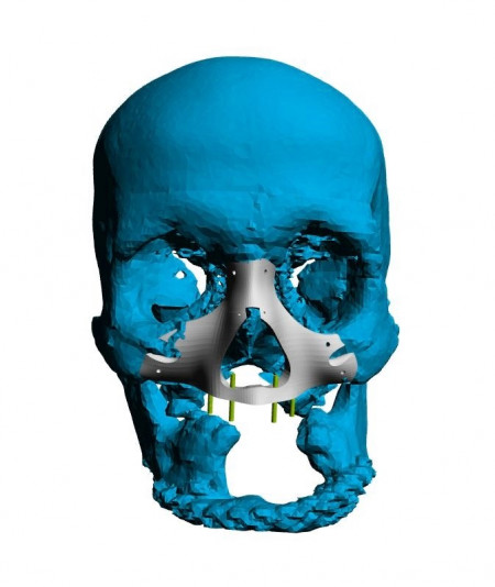 Implant personalizat pentru reconstructia fetei si craniului | 3di Germania - Img 5