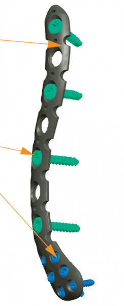 Placa cu extremitate laterala poliaxiala pentru osteointeza fracturii de clavicula