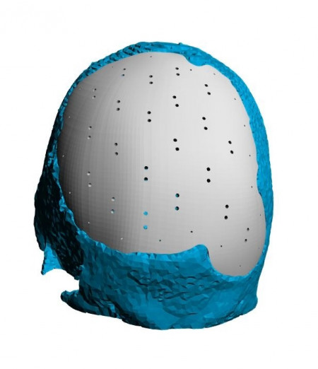 Placa (Cranioplastie), defecte craniene - Img 2