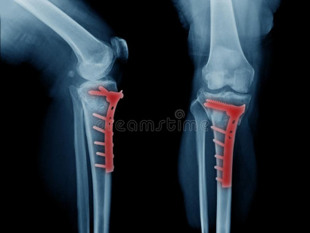 Placa de tibie proximala in T poliaxiala pentru osteosinteza fracturii de tibie Enlife