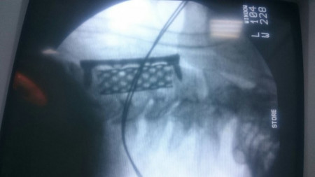 SENTINUS CORPECTOMY MESH CAGES - Img 2