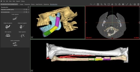 Software pentru planificare chirurgicală cranio-maxilo-facială, chirurgie ortognată – Mimics Enlight CMF (Materialise) - Img 2