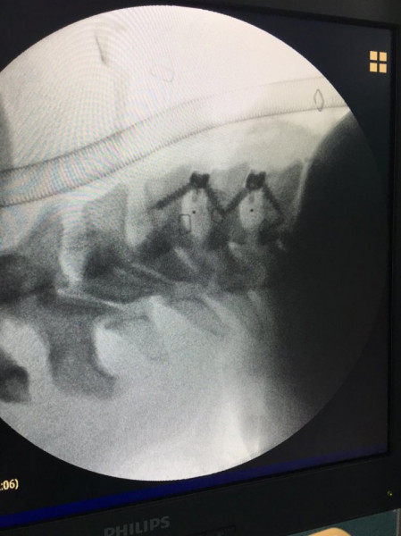 TITANOPEEK STAND ALONE CERVICAL CAGE SYSTEM - Img 5
